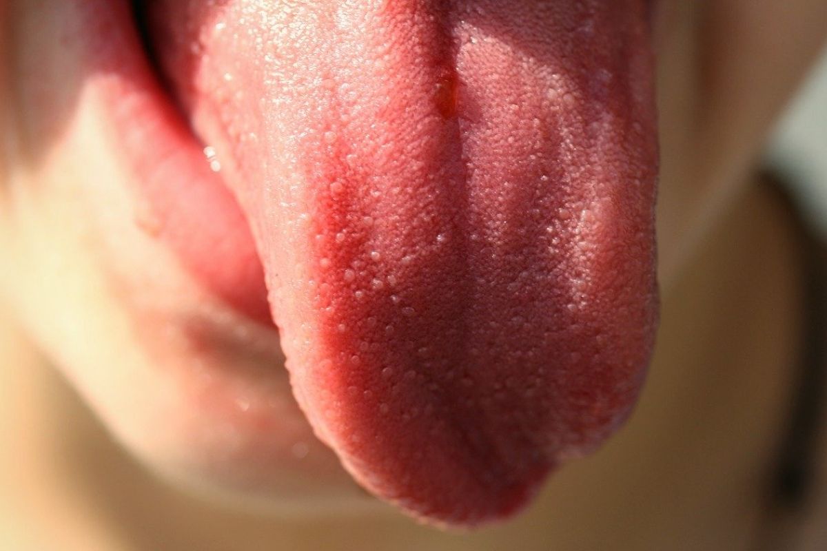 Sariawan bisa jadi tanda awal kanker lidah