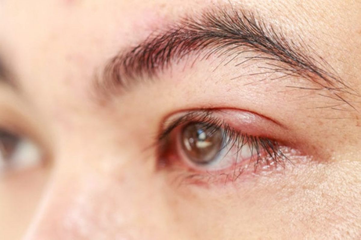 Kurang bersih saat hapus riasan mata dapat sebabkan penyakit hordeolum